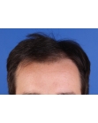 Before Hair Transplant&nbsp;Hairlines